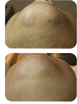 Hair Reduction Laser Treatment Before and After