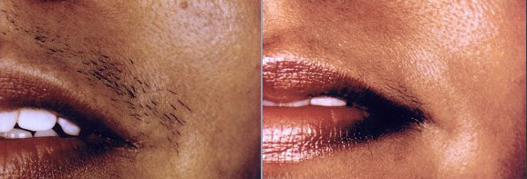 laser hair removal from the upper lip