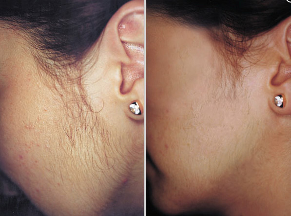 laser hair removal from the face