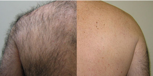 laser hair removal from the back